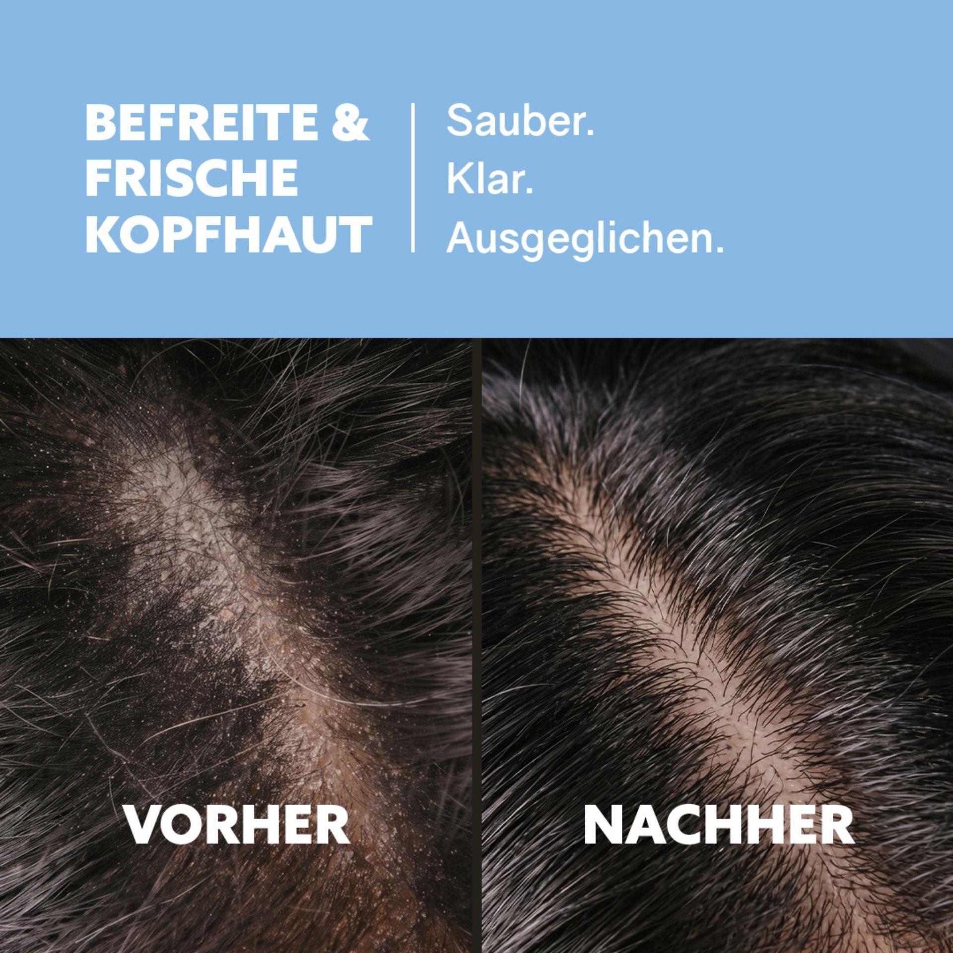 Vorher-Nachher Vergleich einer gereinigten Kopfhaut nach Anwendung des Peelings